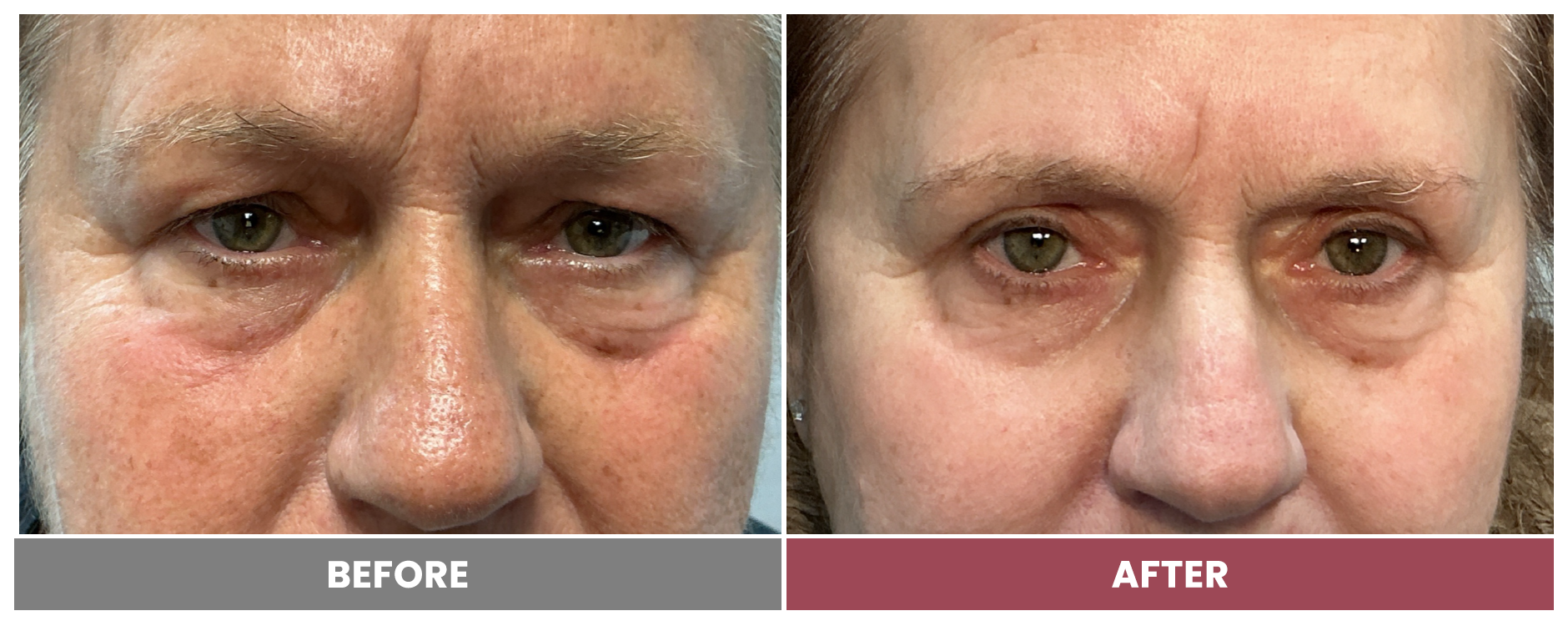Upper Blepharoplasty - Case lucia-fierro-vogel